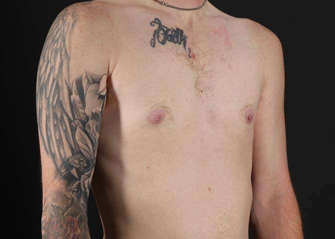 FTM Chest Contouring Before & After Patient #1864
