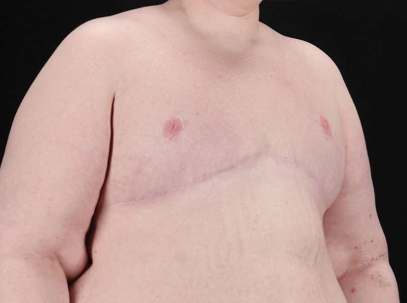 FTM Chest Contouring Before & After Patient #1875