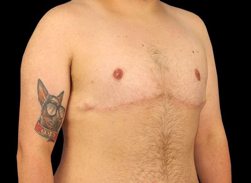 FTM Chest Contouring Before & After Patient #1886