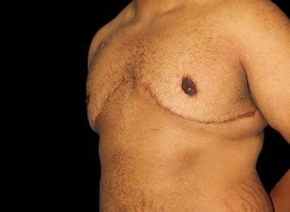 FTM Chest Contouring Before & After Patient #1893