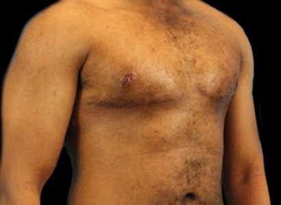 FTM Chest Contouring Before & After Patient #1907