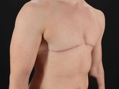 FTM Chest Contouring Before & After Patient #1918