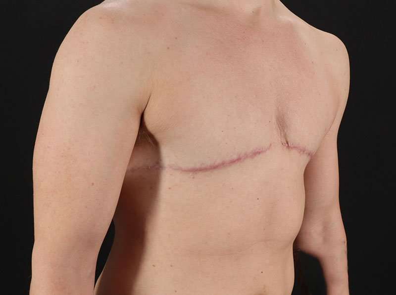 FTM Chest Contouring Before & After Patient #1918