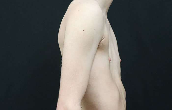 FTM Chest Contouring Before & After Patient #1940
