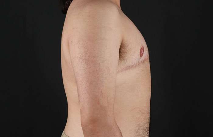 FTM Chest Contouring Before & After Patient #1951