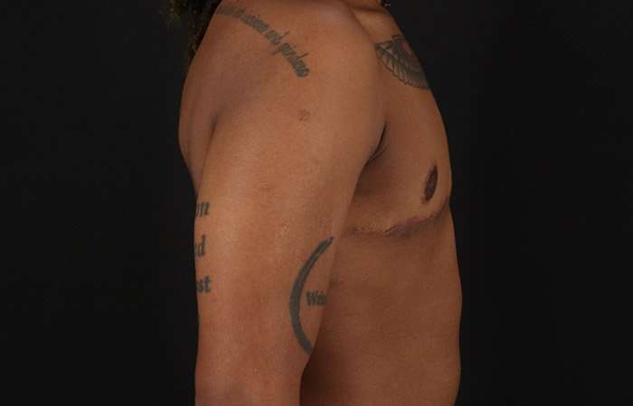 FTM Chest Contouring Before & After Patient #1962