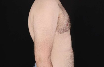 FTM Chest Contouring Before & After Patient #1984