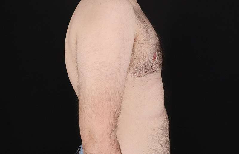 FTM Chest Contouring Before & After Patient #1984