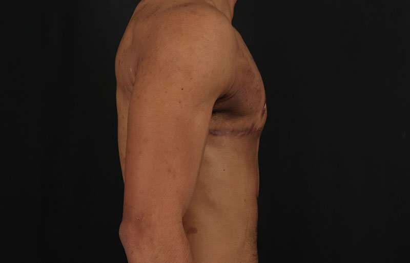 FTM Chest Contouring Before & After Patient #1995