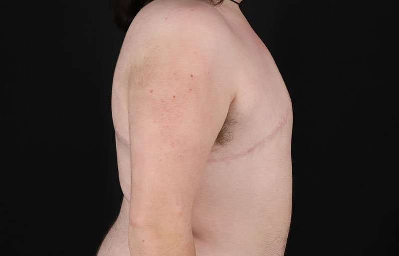 FTM Chest Contouring Before & After Patient #2006