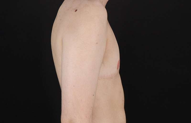 FTM Chest Contouring Before & After Patient #2017