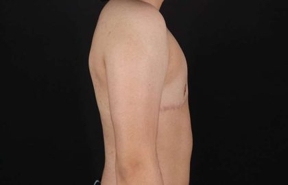 FTM Chest Contouring Before & After Patient #2028