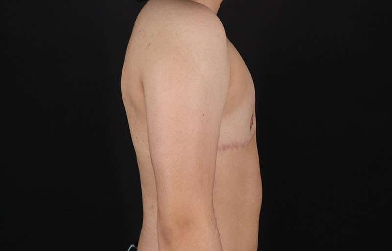 FTM Chest Contouring Before & After Patient #2028