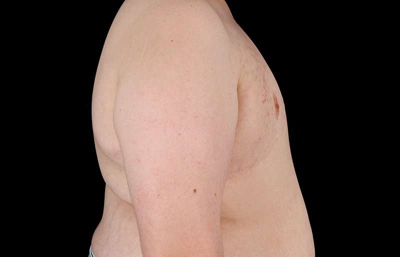 FTM Chest Contouring Before & After Patient #2039