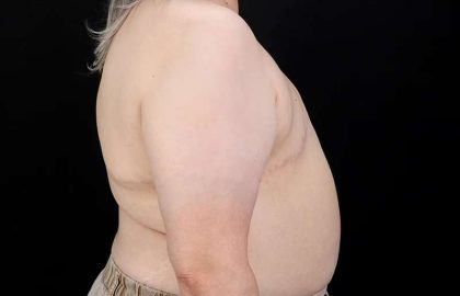 FTM Chest Contouring Before & After Patient #2050