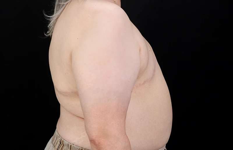 FTM Chest Contouring Before & After Patient #2050