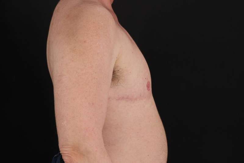 FTM Chest Contouring Before & After Patient #2061