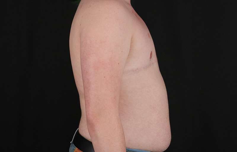 FTM Chest Contouring Before & After Patient #2072