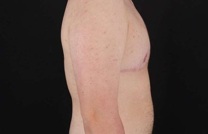 FTM Chest Contouring Before & After Patient #2083
