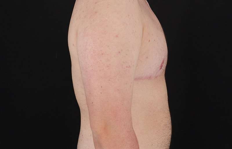 FTM Chest Contouring Before & After Patient #2083