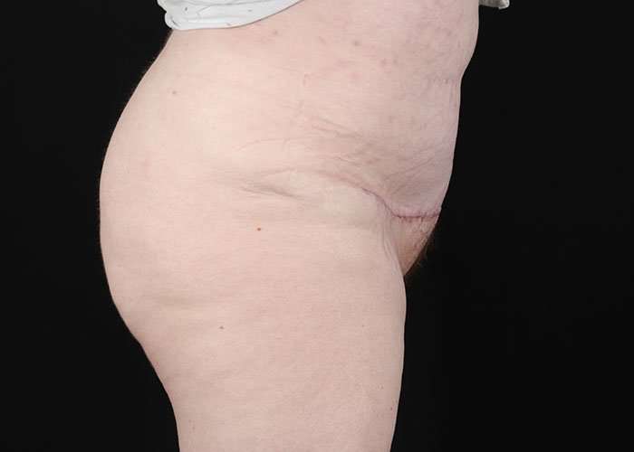 Monsplasty Before & After Patient #2106