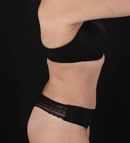 Tummy Tuck Before & After Patient #2128