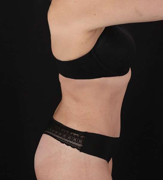 Tummy Tuck Before & After Patient #2128