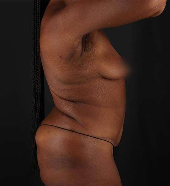 Tummy Tuck Before & After Patient #2139