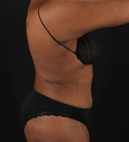 Tummy Tuck Before & After Patient #2146