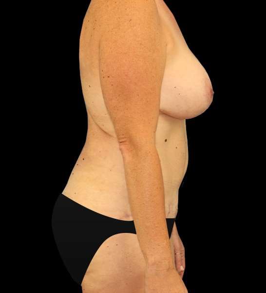 Tummy Tuck Before & After Patient #2157
