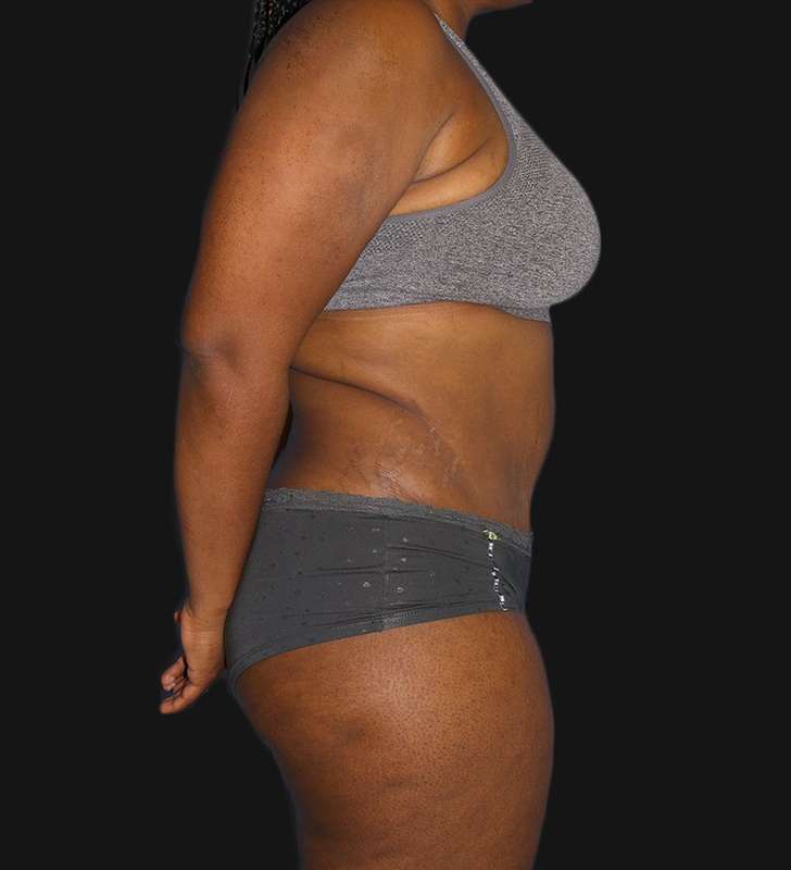 Tummy Tuck Before & After Patient #2179