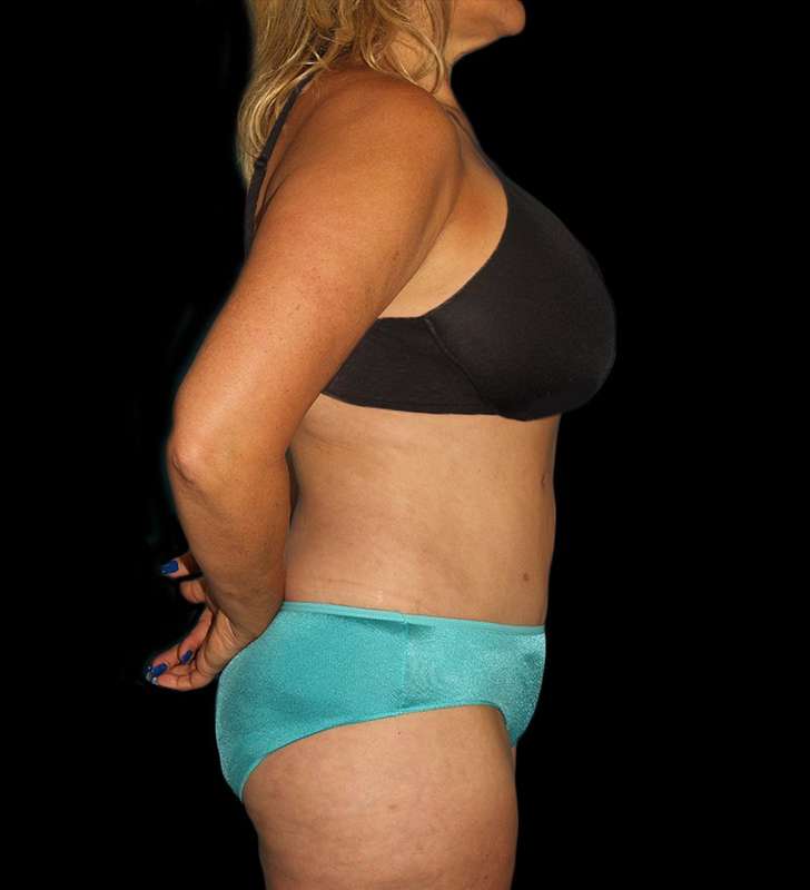 Tummy Tuck Before & After Patient #2190