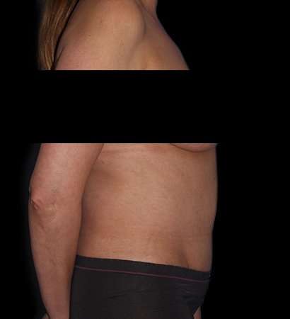 Tummy Tuck Before & After Patient #2201