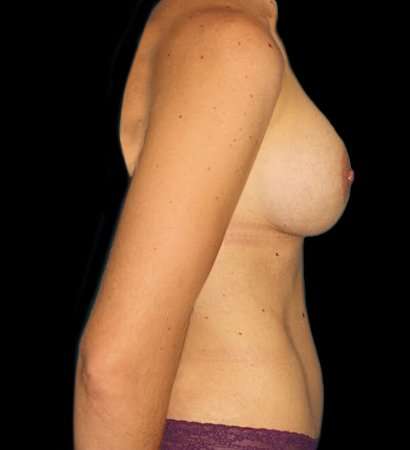 Tummy Tuck Before & After Patient #2223