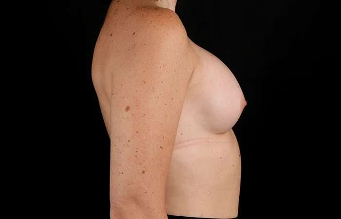 Breast Augmentation - Implant Before & After Patient #1012
