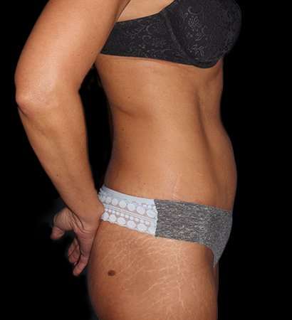 Tummy Tuck Before & After Patient #2269