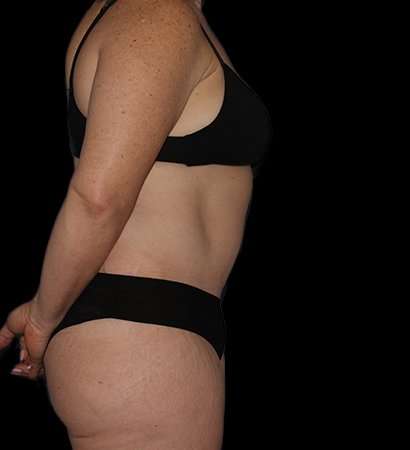 Tummy Tuck Before & After Patient #2280