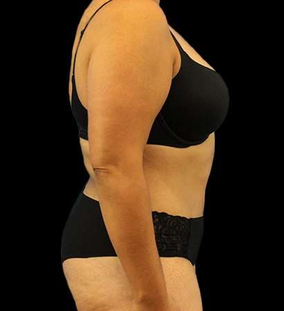 Tummy Tuck Before & After Patient #2291