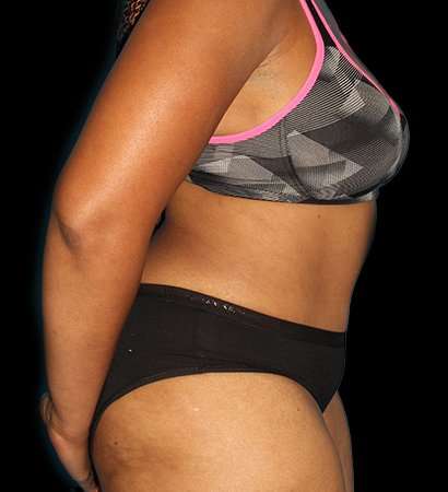 Tummy Tuck Before & After Patient #2302