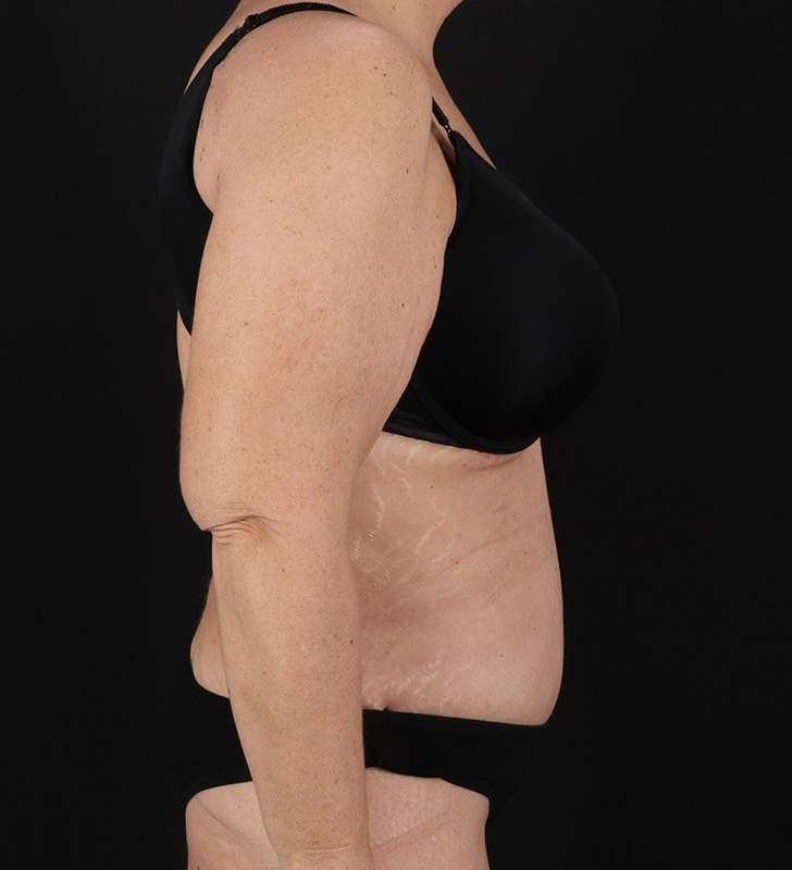 Tummy Tuck Before & After Patient #2326