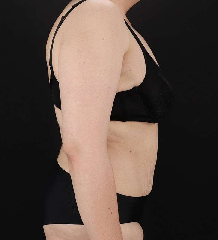 Tummy Tuck Before & After Patient #2339