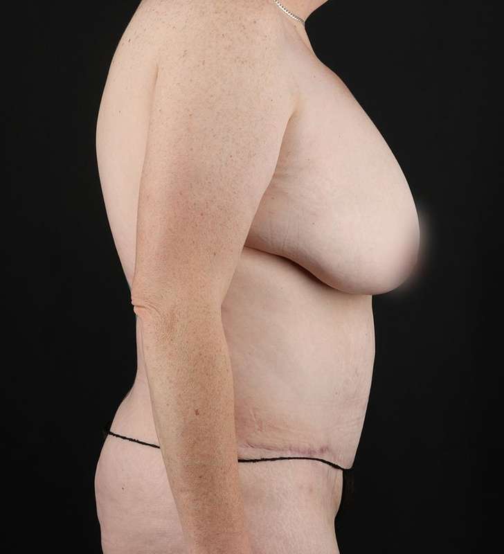 Tummy Tuck Before & After Patient #2363