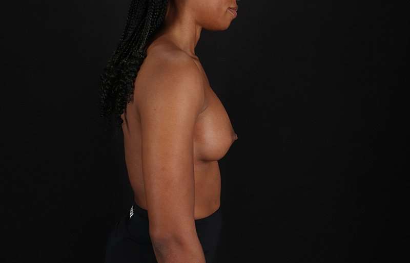 Breast Augmentation - Implant Before & After Patient #1023