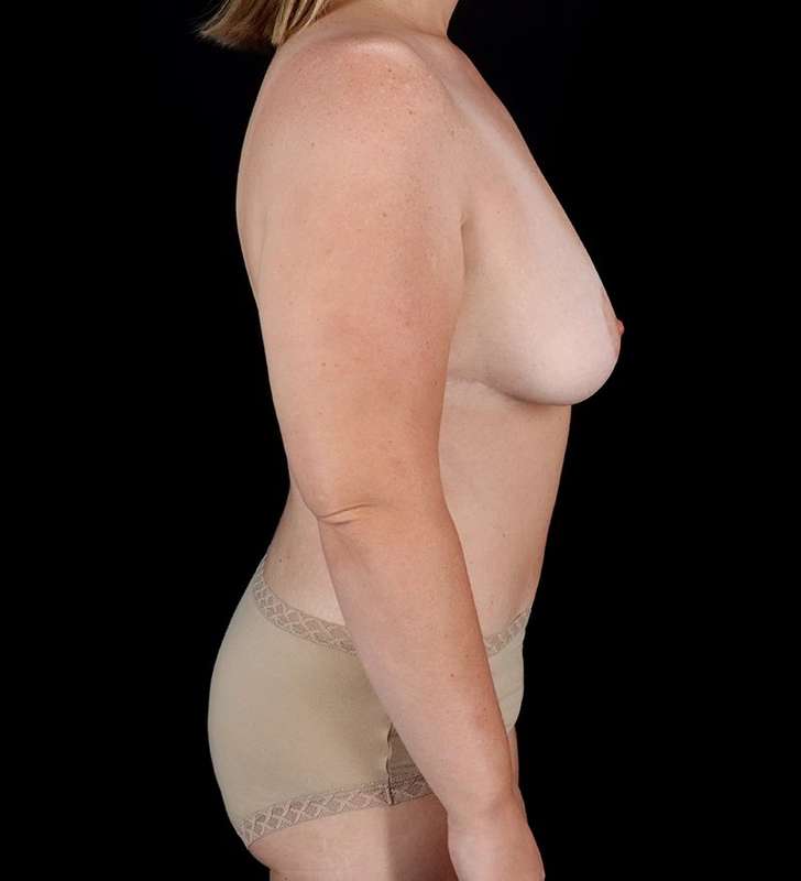 Tummy Tuck Before & After Patient #2413