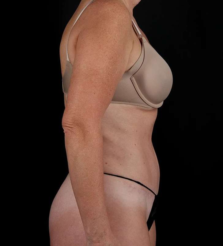 Tummy Tuck Before & After Patient #2435