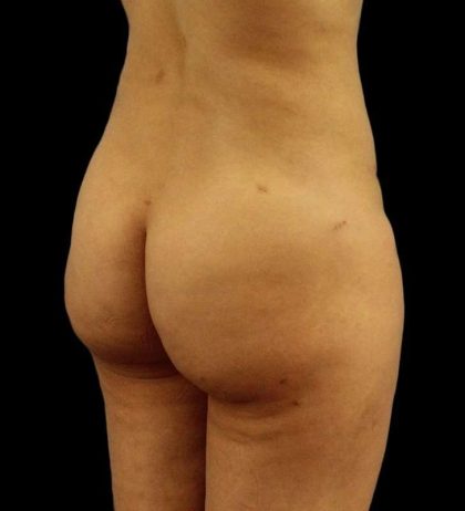 Brazilian Butt Lift Before & After Patient #2496