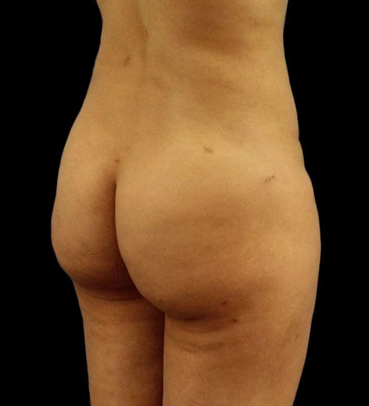Brazilian Butt Lift Before & After Patient #2496