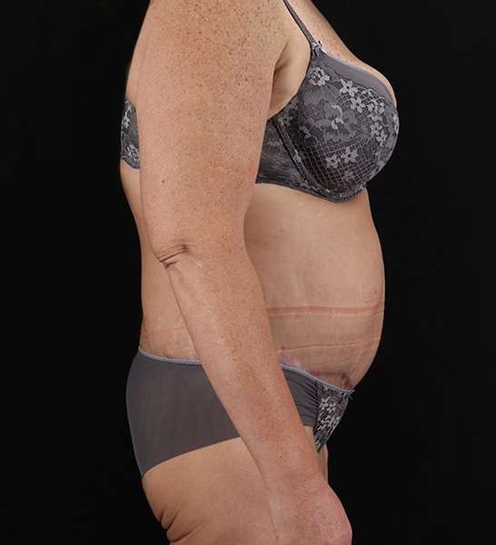 Circumferential Body Lift Before & After Patient #2509