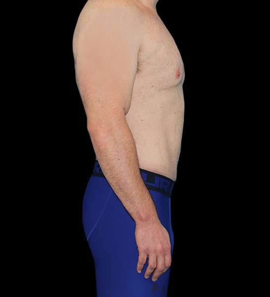 Circumferential Body Lift Before & After Patient #2522