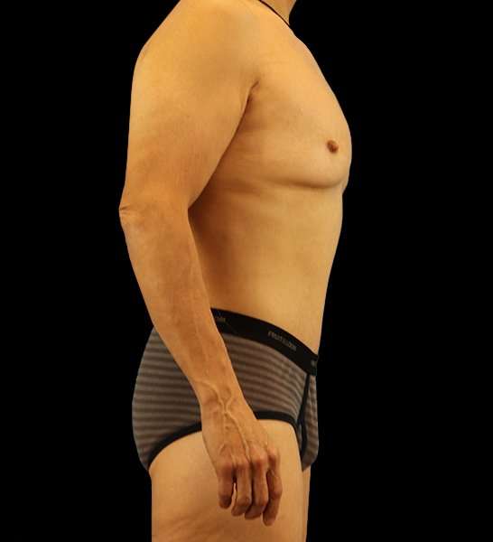 Circumferential Body Lift Before & After Patient #2535